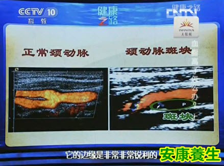 颈动脉B超