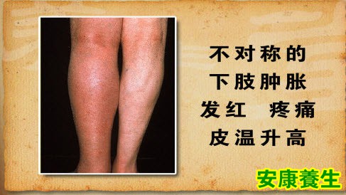 血栓的腿部症状