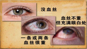 养生堂20130218视频:王宏宇讲血管老化、眼底出血、心绞痛和血管健康的关联、饮食调节  ...