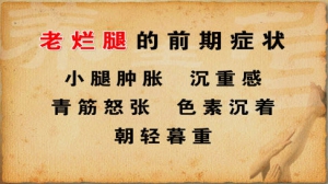养生堂20130205视频:董建勋讲静脉曲张、老烂腿的前期症状、危害、坐姿和血液循环的关  ...