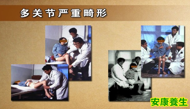 多关节严重畸形