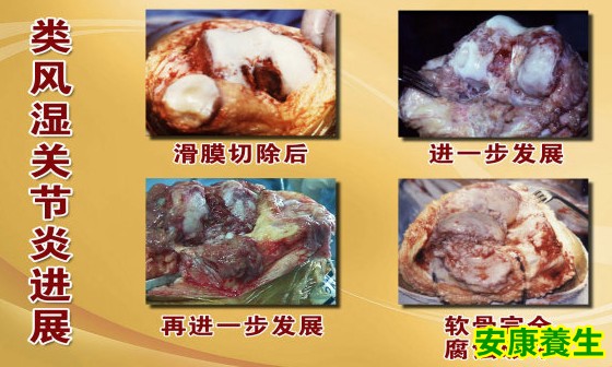 类风湿关节炎进展