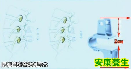 腰椎管狭窄微创手术