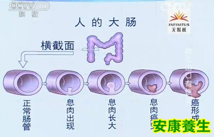 怎样从便血识别痔疮和肠癌