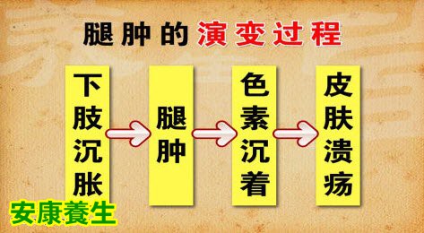 哪些腿肿需要就医