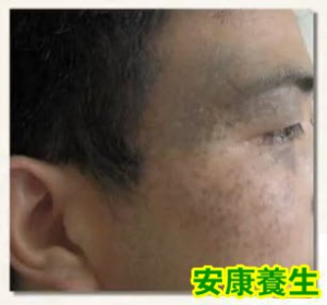 爱尚健康20130808视频:于艳菊讲胎记也是一种病,美容,整容