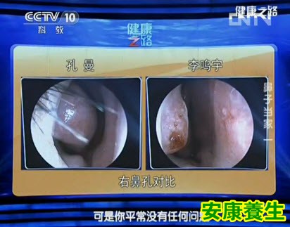 鼻中隔