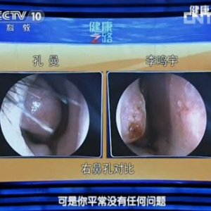 健康之路视频和笔记:周兵讲鼻子,鼻塞,鼻梁,嗅觉,鼻中隔