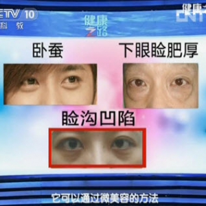 健康之路视频:范先群讲小整形大改变 肿眼泡 眼袋 卧蚕 下眼睑肥