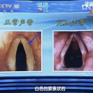 健康之路视频和笔记:徐振明讲健康好声音 声带 变声期 用嗓过度