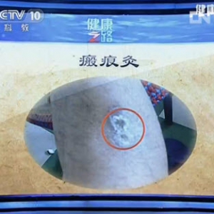健康之路视频:程凯讲胃寒 瘢痕灸 胃胀 滑肉门 艾灸