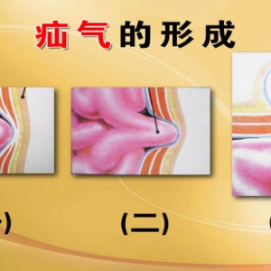 养生堂视频鲁纯智:疝气的形成 原因 高危人群 诱发腹压增高