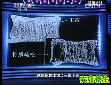 骨质疏松