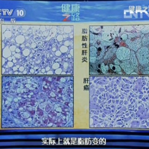 健康之路20130924视频:贾继东讲导致脂肪肝最常见的原因 危害 脂肪肝为何会变肝癌