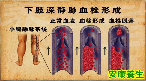 下肢静脉血栓的形成