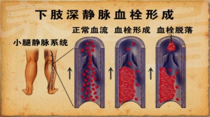 养生堂20130302视频:王辰讲肺栓塞的症状和猝死、哪些人需要小心肺栓塞、肺栓塞的早期  ...
