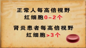 养生堂20130228视频:聂莉芳讲感冒和肾病的关系、肾病的常见症状、血尿的检测判定标准  ...