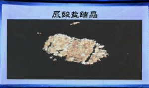 健康之路20131021视频:刘湘源讲痛风高危人群，尿酸高是痛风吗、痛风发作时多数从哪 .. ...