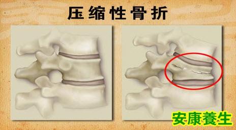 腰痛