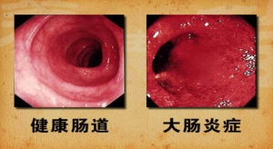 北京卫视20131122养生堂视频:王化虹 张谦讲免疫系统、肠道菌群、肠道年龄、膳食纤维