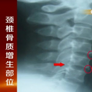 健康有道20131127视频:沈彤讲骨质增生、易骨质增生的部位、补钙会加重骨质增生吗