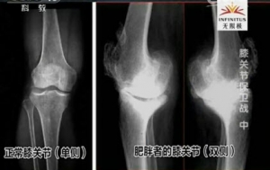 健康之路20131128视频:寇伯龙讲肥胖带来的膝关节问题、膝关节肌肉锻炼操、保护膝关节  ...