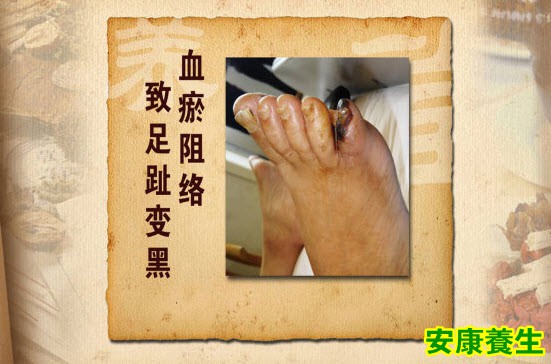 血瘀阻络
