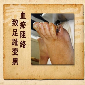 养生堂20131212视频和笔记:吕培文讲血瘀阻络,首乌藤,寒湿阻络,首乌藤洗剂,首乌藤粥