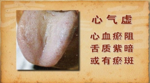 养生堂20131224视频:于作洋讲心气不足,心气虚,心火虚,舌象,补益心气茶,补益清心茶