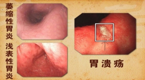 养生堂20131228视频和笔记:苏向前讲胃癌的癌前病变,胃炎,胃溃疡,息肉