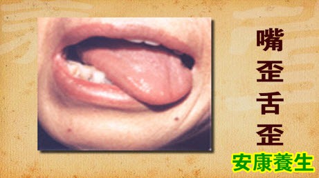 脑卒中前兆