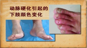 养生堂20131231视频和笔记:王正义讲八字脚,间歇性跛行,腰椎狭窄