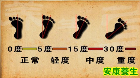 外八字的判断方法