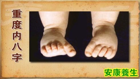 重度内八字