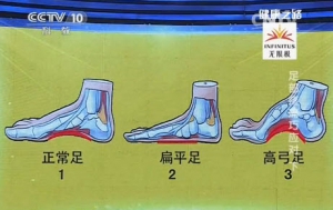 健康之路20131220视频和笔记:温建民讲扁平足,高弓足,拇外翻