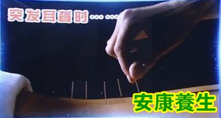 突发性耳聋