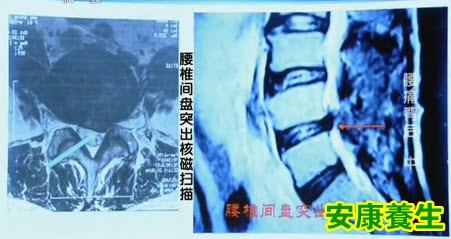 腰椎间盘突出