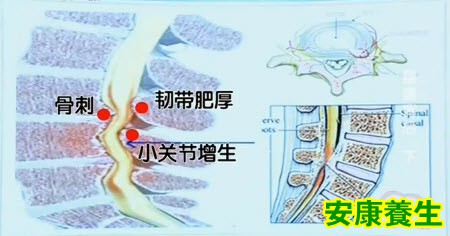 腰椎管狭窄是怎么造成的