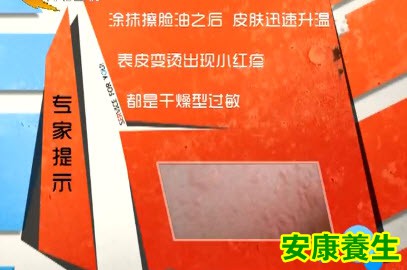 干燥型过敏的表现