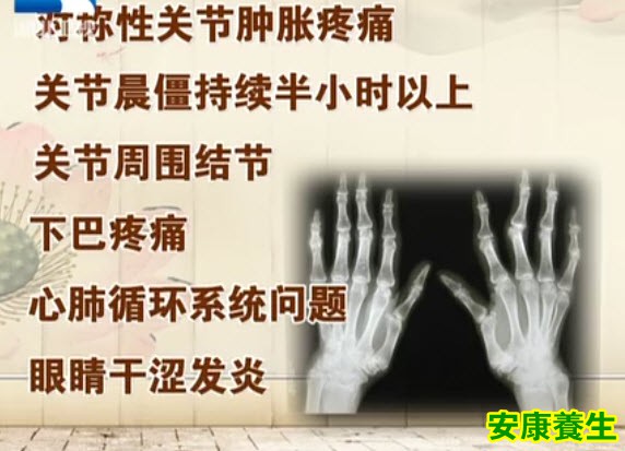 骨关节炎