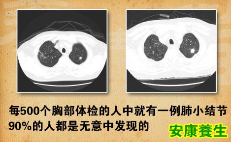 肺小结节