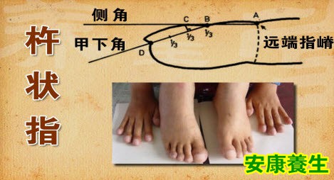 杵状指
