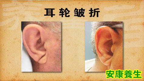 耳垂皱折