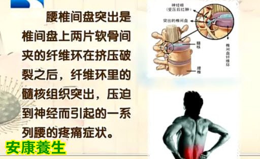 腰椎间盘突出