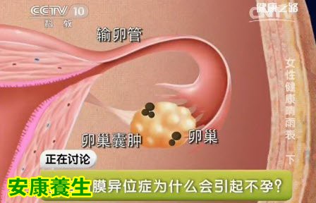 子宫内膜异位症最常见的危害是不孕