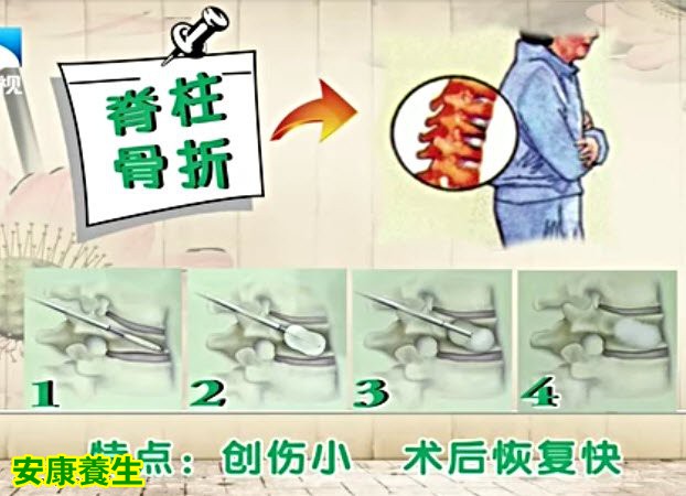 手腕骨折手术治疗