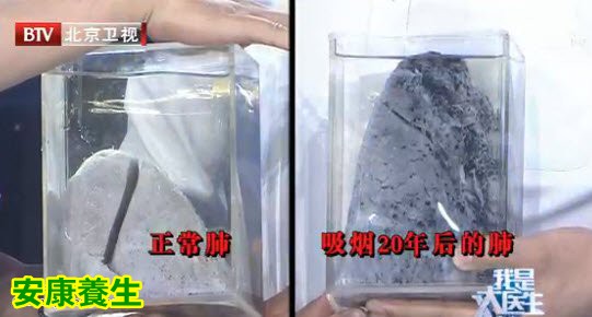 正常肺与煤渣肺