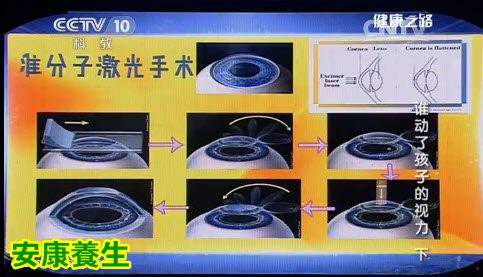 近视眼手术不同于戴眼镜