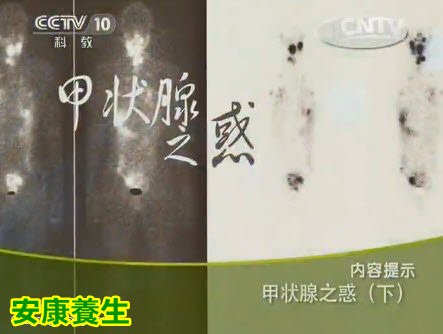 不明原因的疲劳犯困有可能跟甲状腺有关