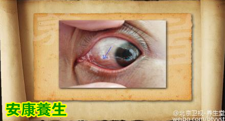 20150401养生堂视频和笔记:五脏的阴虚表现及调理 脾阴虚和肾阴虚的表现